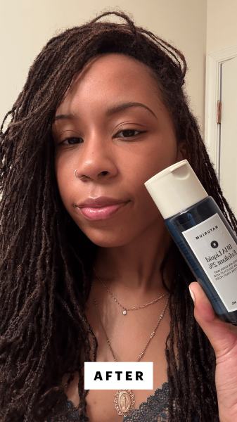 Taylor after applying the Naturium BHA Liquid Exfoliant